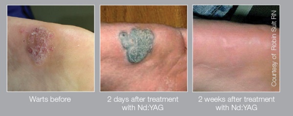 Warts Removal